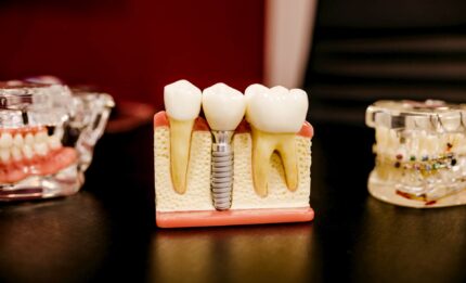 Co to jest implant zęba?